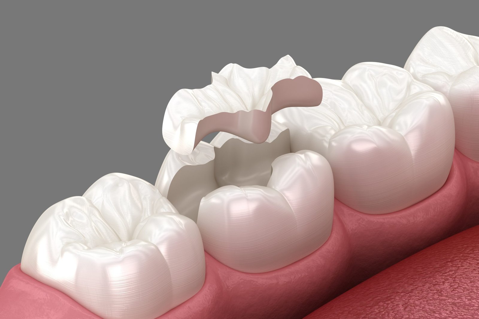 Lost filling crown or bridge tooth in Beverly Hills