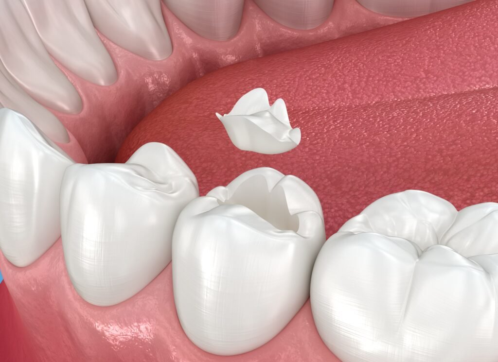 Lost filling crown or bridge tooth in Beverly Hills