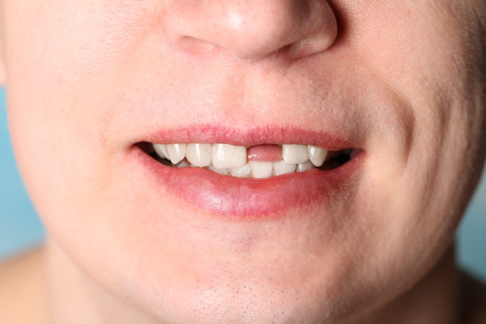 Tooth Knocked Out in Beverly Hills